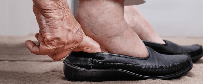 Retención de líquido o edema en adulto mayor